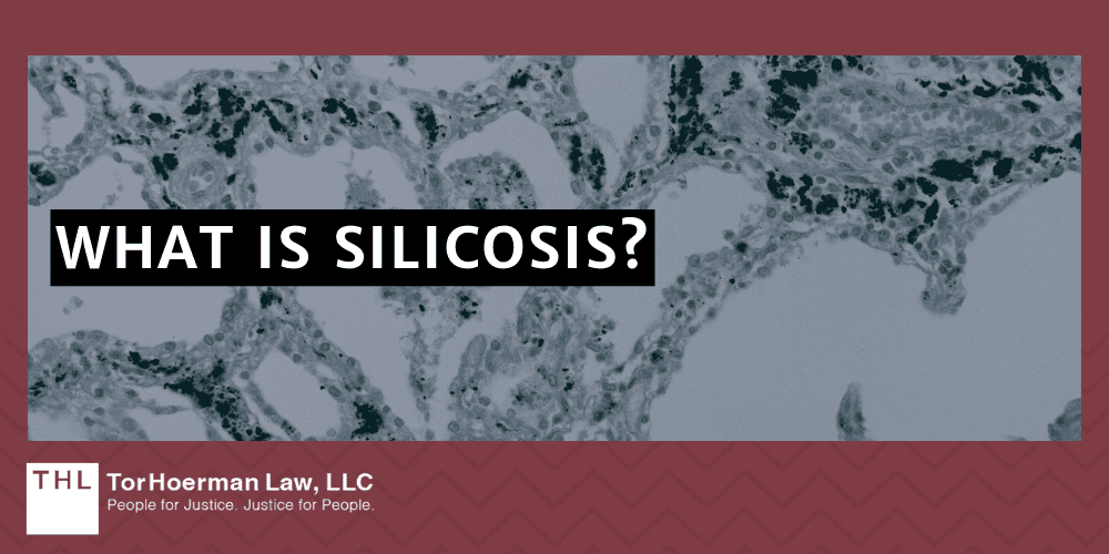 Silicosis Lawsuit; Silica Dust Exposure; Silica Exposure Lawsuit; Silica Lawsuit; Silicosis Lawsuit Overview; What Is The Average Silicosis Lawsuit Settlement Amount; Who Are Silicosis Lawsuits Filed Against;  Health Risks Of Silica Exposure; What Is Silicosis