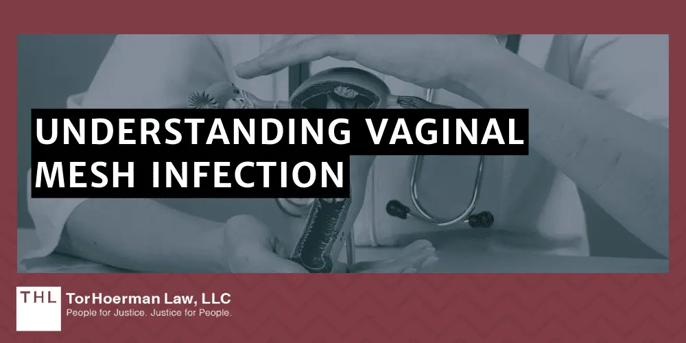 Vaginal Mesh Infection Lawsuit; vaginal mesh infection; transvaginal mesh lawsuit; transavgainal mesh injuries; transvaginal mesh lawyer; vaginal mesh lawsuit; What is Vaginal Mesh; Pelvic Organ Prolapse (POP); Stress Urinary Incontinence (SUI); Understanding Vaginal Mesh Infection