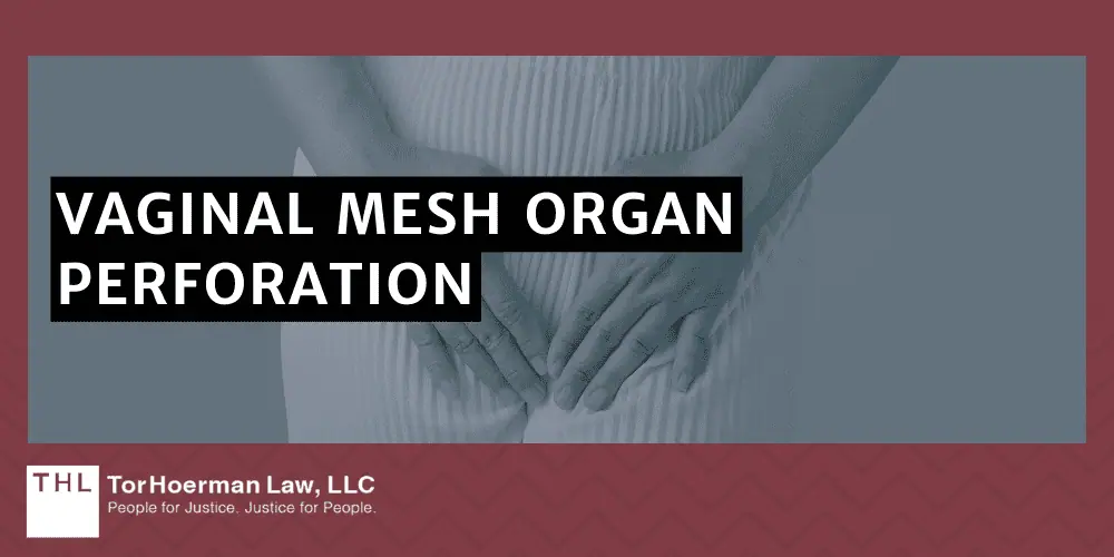 Vaginal Mesh Organ Perforation Lawsuit; vaginal mesh organ perforation; vaginal mesh lawsuit; transvaginal mesh settlement; transvaginal mesh lawsuit; On The Use Of Vaginal Mesh; Vaginal Mesh Organ Perforation